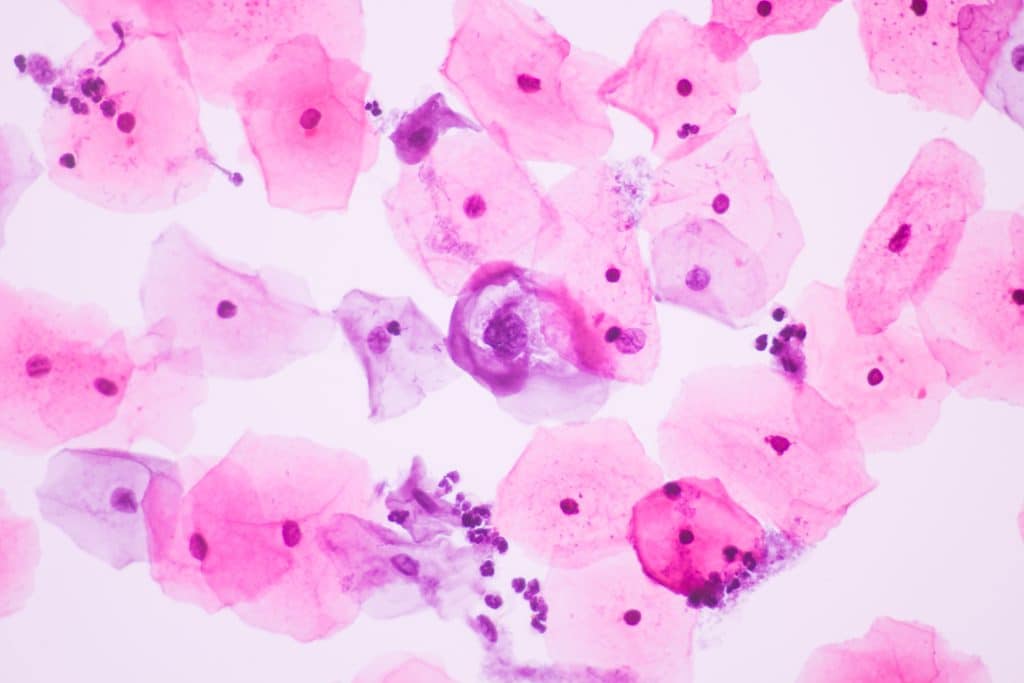 HPV-Abstrich. Dysplasie-Sprechstunde für Bielefeld Schildesche, Bielefeld Sieker, Bielefeld Mitte, Bielefeld Senne an. PAP II-P Abstrich pap II-P Abstrich PAP II-D2 HPV positiv II-g